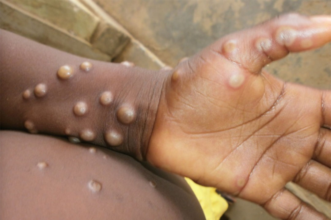 Zimbabwe don report di first two cases of mpox wey no get specified variant